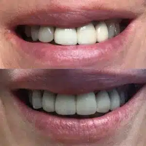 Smile before and after